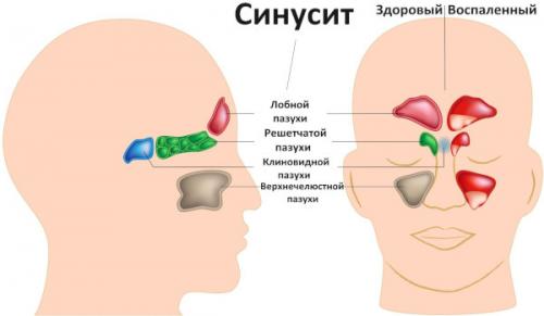 Как правильно ставить турунды и нужно ли это. Противопоказания и возможные осложнения