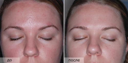 Кальция хлорид и мыло. Особенности проведения пилинга с детским мылом и кальцием хлоридом