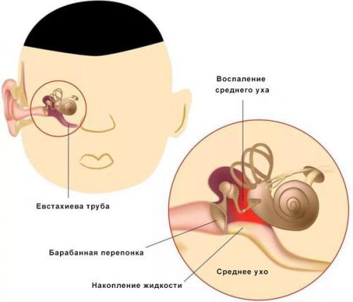 Противомикробное средство для уха: как правильно использовать борный спирт 02